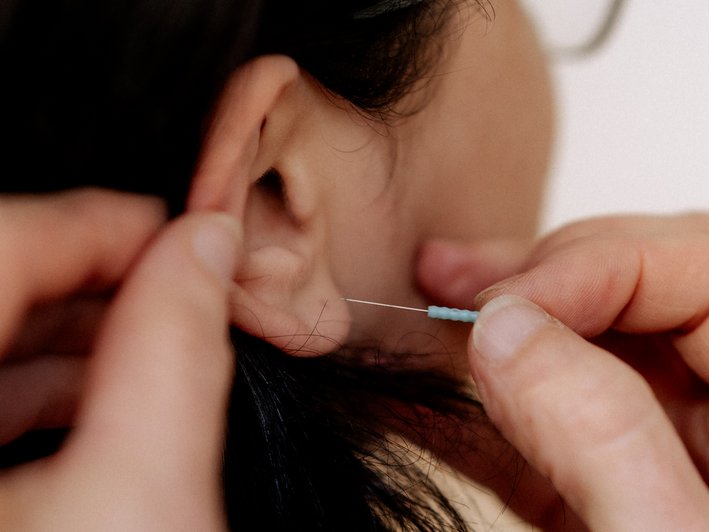 Frau bekommt Akupunkturnadel ins Ohr gestochen